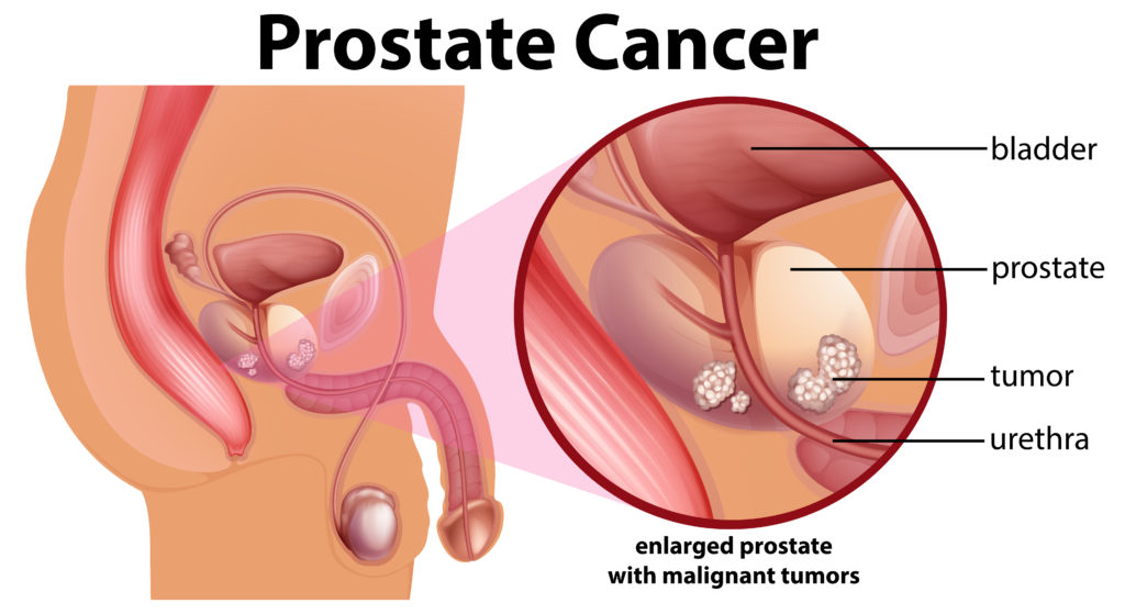 Abcès de la prostate - Problèmes de santé de l’homme - Manuels MSD pour le grand public